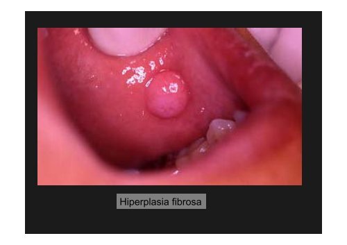 Curso Diagnóstico precoz del cáncer oral.