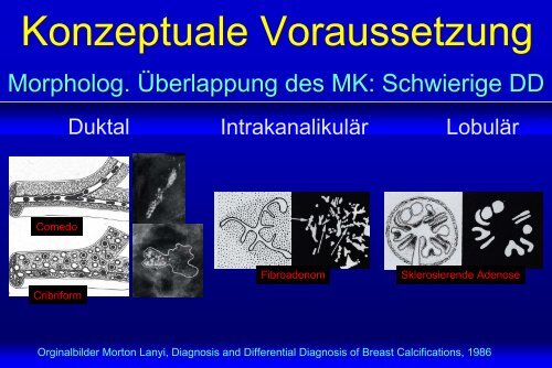 A. Mundinger Mikrokalk-Anordnung und Malignomrisiko ...