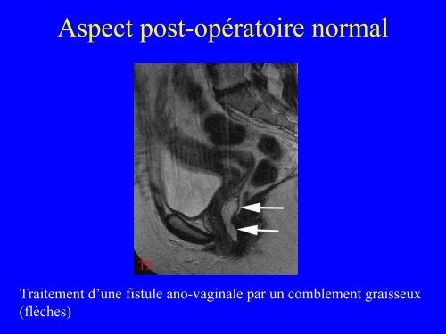 IRM du canal anal : anatomie et pathologie