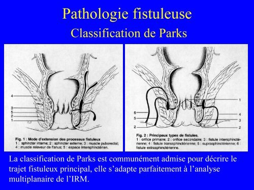 IRM du canal anal : anatomie et pathologie