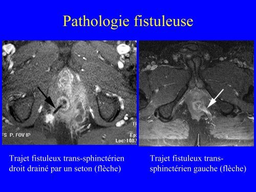 IRM du canal anal : anatomie et pathologie