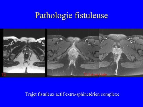 IRM du canal anal : anatomie et pathologie