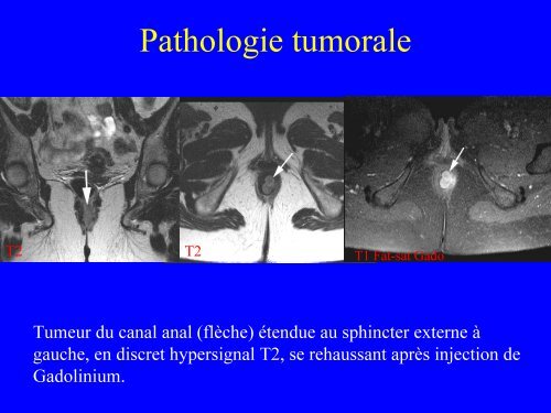 IRM du canal anal : anatomie et pathologie