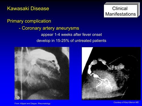 Vasculitis - Langford.pdf - AInotes