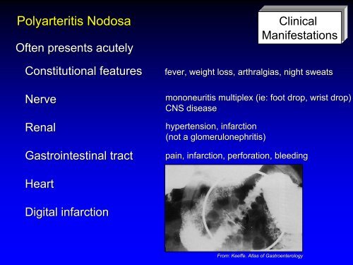 Vasculitis - Langford.pdf - AInotes