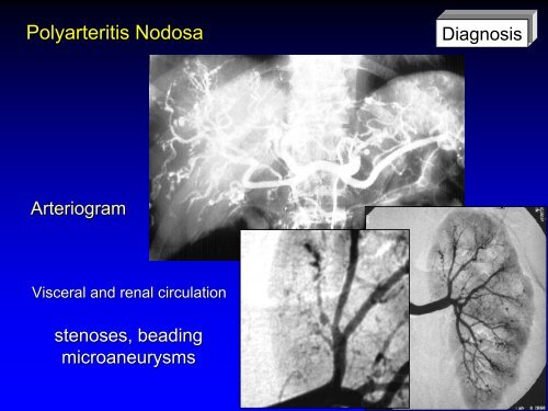 Vasculitis - Langford.pdf - AInotes