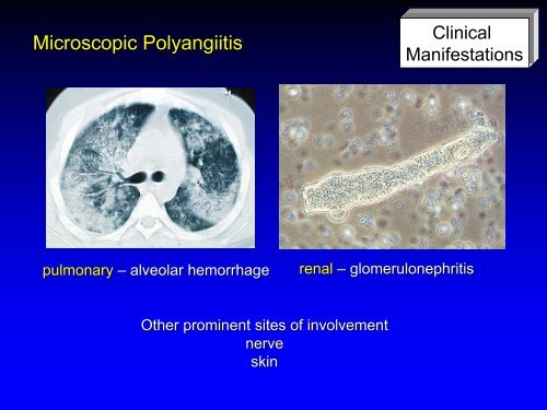 Vasculitis - Langford.pdf - AInotes