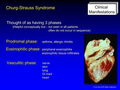 Vasculitis - Langford.pdf - AInotes