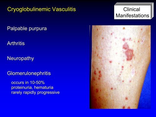 Vasculitis - Langford.pdf - AInotes