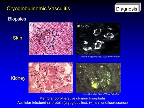 Vasculitis - Langford.pdf - AInotes