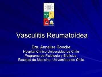 Vasculitis ReumatoÃ­dea