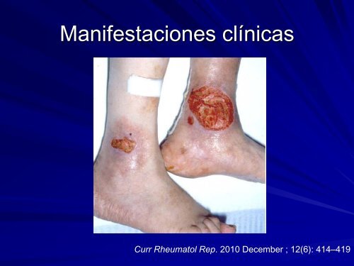 Vasculitis ReumatoÃ­dea