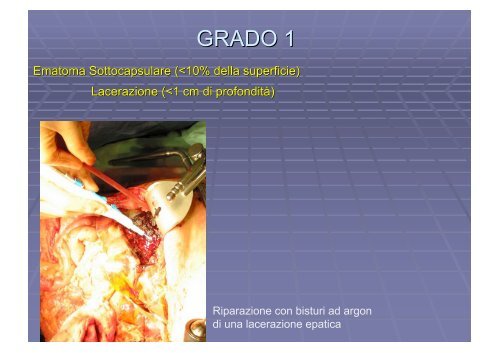 Ascesso epatico echinococco trauma