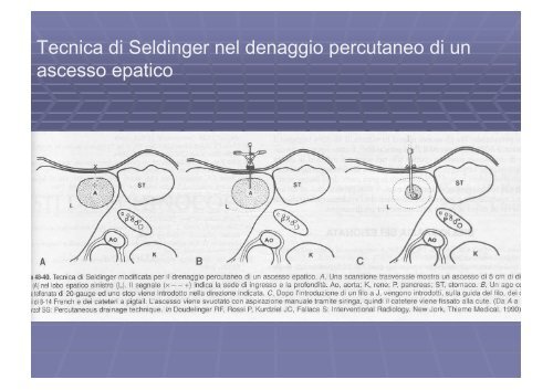 Ascesso epatico echinococco trauma