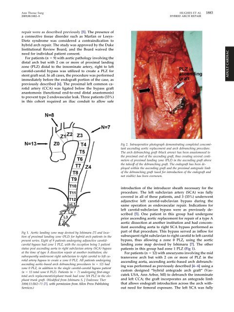 “Hybrid” Repair of Aneurysms of the Transverse Aortic Arch: Midterm ...