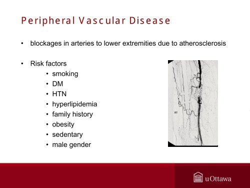 Peripheral Endovascular Therapy