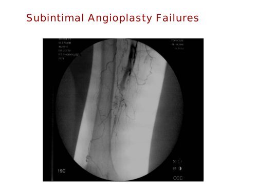 Peripheral Endovascular Therapy