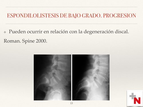 ESPONDILOLISTESIS AH