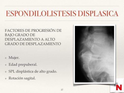 ESPONDILOLISTESIS AH