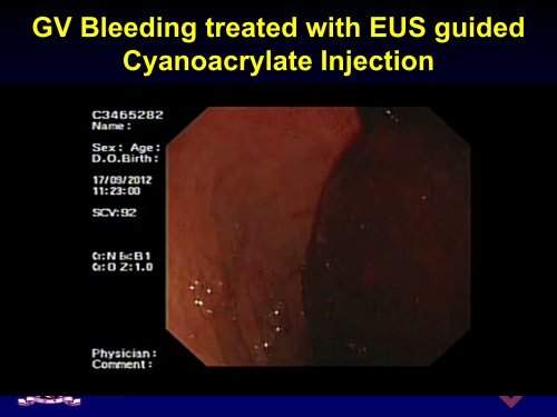 Acute Variceal Bleeding