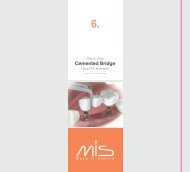 Cemented Bridge Cemented Bridge - Mis Implants