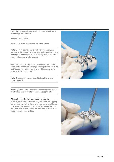 The Locking Calcaneal Plate. Part of the Synthes small fragment ...