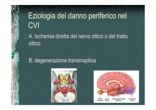 Il nervo ottico nel CVI - E. Medea