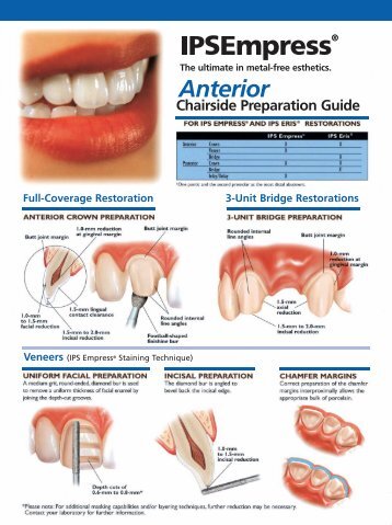 IPS Empress Prep Guide - Ivoclar Vivadent