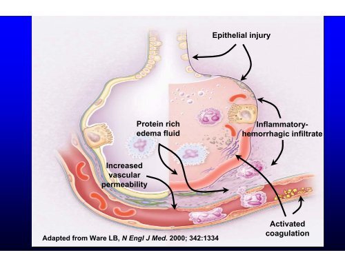 Acute lung injury (ALI) and Acute respiratory distress syndrome ...