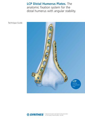 LCP Distal Humerus Plates. The anatomic fixation ... - Osteosyntese