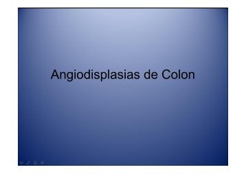Angiodisplasias de Colon