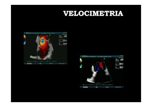 Ecocardiochirurgia: in quali situazioni l'accoppiata ÃƒÂ¨ indispensabile?