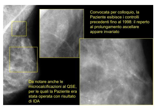 Microbiopsia stereo-guidata