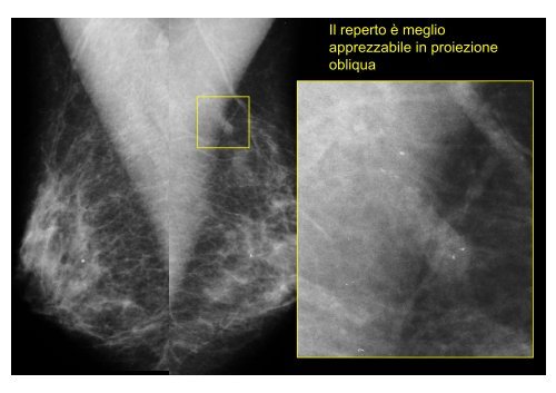 Microbiopsia stereo-guidata