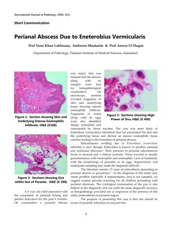 Perianal Abscess Due to Eneterobius Vermicularis - International ...