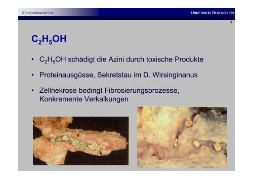 Chronische Pankreatitis