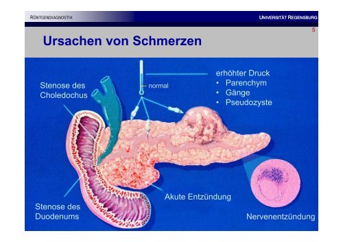 Chronische Pankreatitis