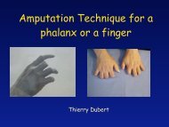 Technique d'amputation d'une phalange ou d'un doigt - ClubOrtho.fr