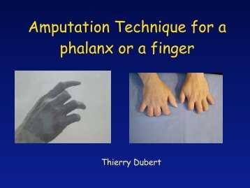 Technique d'amputation d'une phalange ou d'un doigt - ClubOrtho.fr