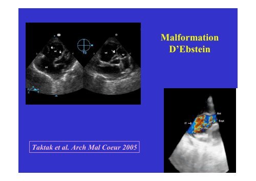 Echocardiographie 3D & Valve Mitrale - Cardiologie-francophone