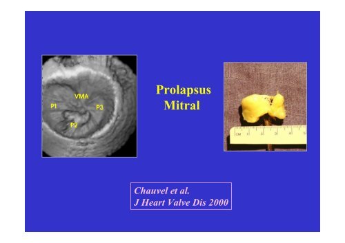 Echocardiographie 3D & Valve Mitrale - Cardiologie-francophone