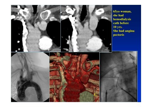 Vascular intervention