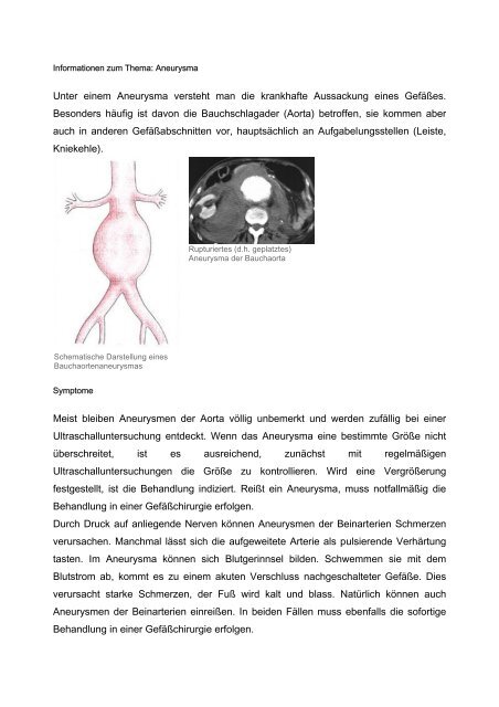 Unter einem Aneurysma versteht man die krankhafte Aussackung ...