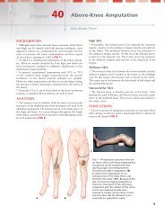 Above-Knee Amputation - Sarcoma.org