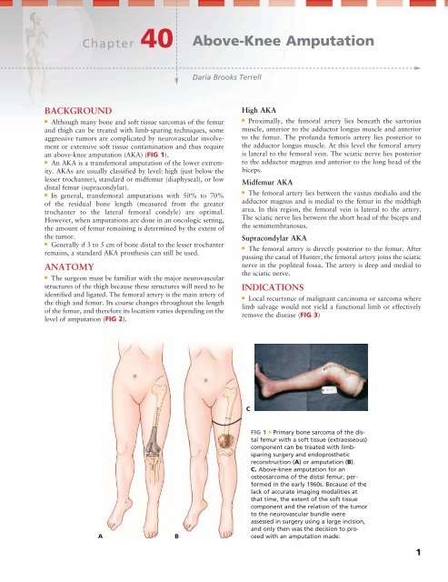 Above Knee Prosthesis - Above Knee Amputation - Amputees - What We Treat 