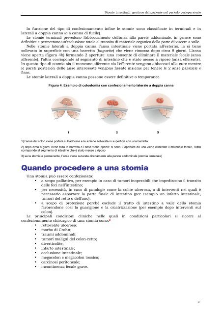 Stomie Intestinali Gesti - 