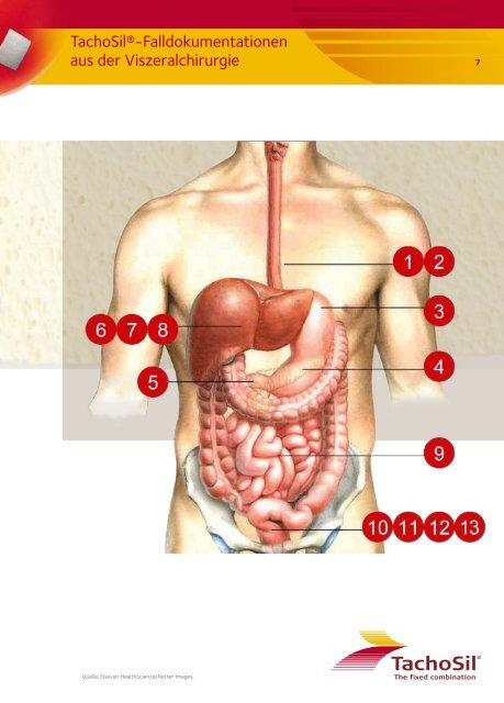 TachoSilÂ® hÃ¤lt dicht. - Takeda Forum