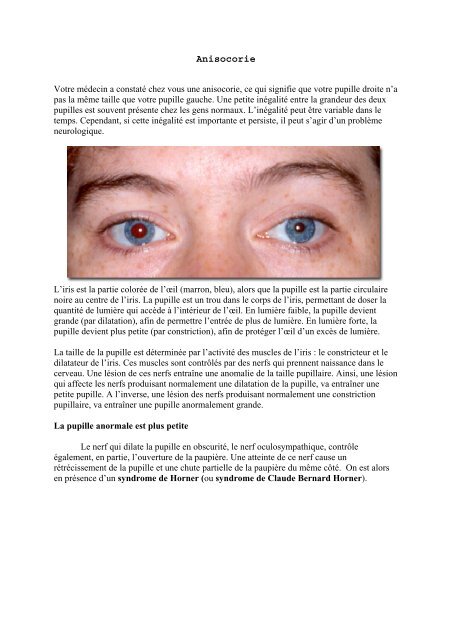 French_Anisocoria