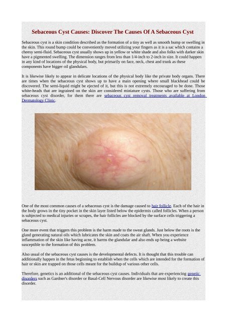 Sebaceous Cyst Causes Discover The Causes Of A Sebaceous Cyst