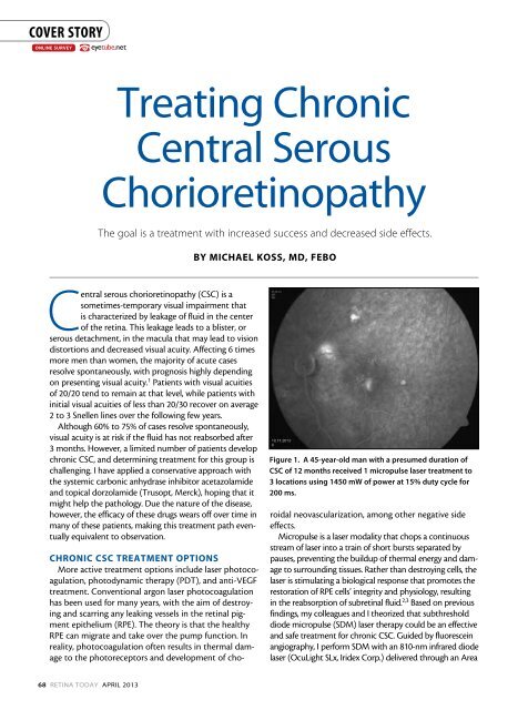 Treating Chronic Central Serous Chorioretinopathy